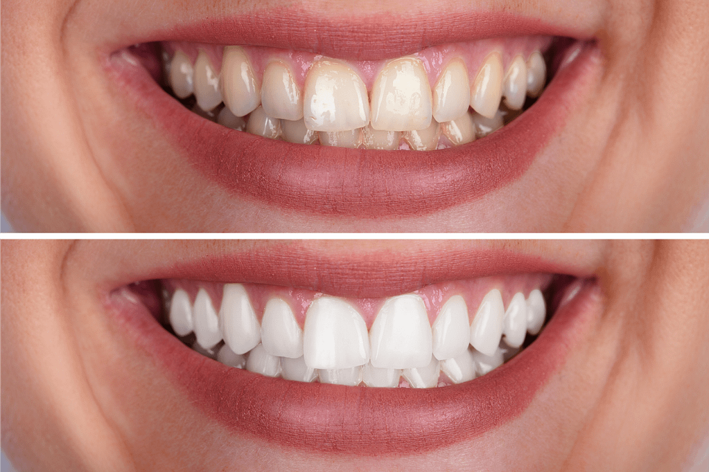 results after teeth whitening