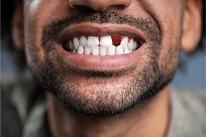 what happens after tooth loss