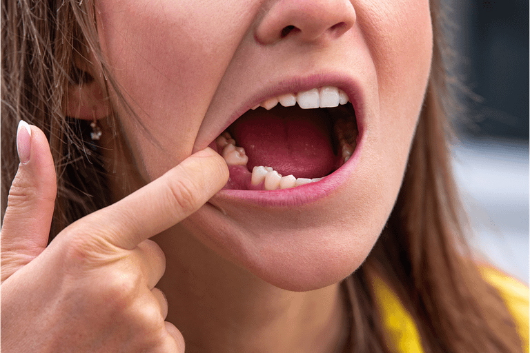 what happens after tooth loss?